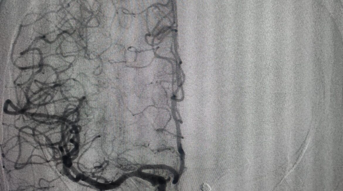 Angiografia cerebral