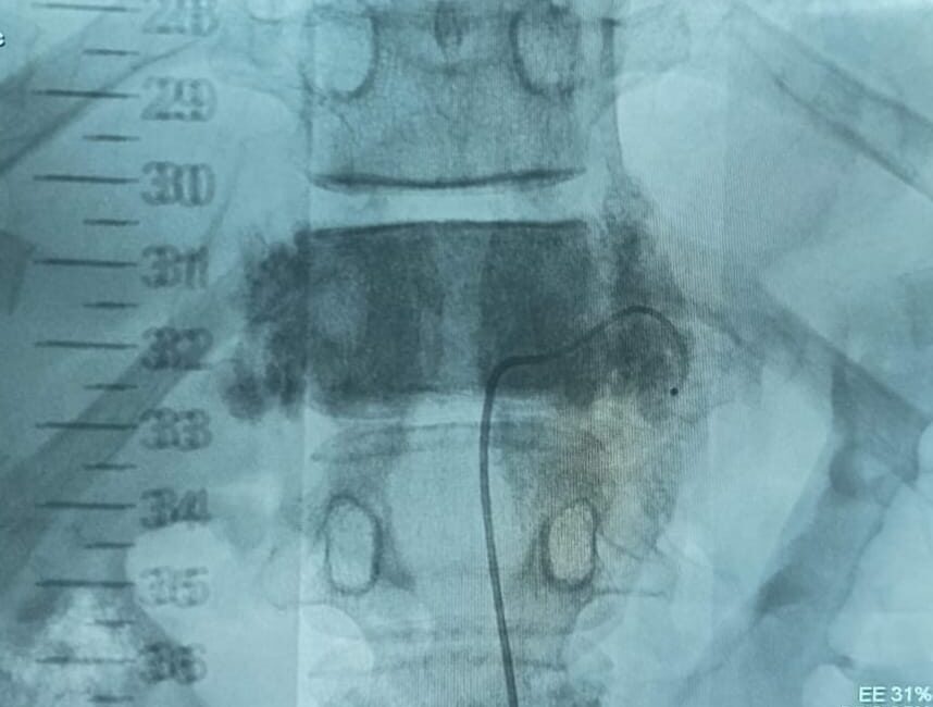 Angiografia medular