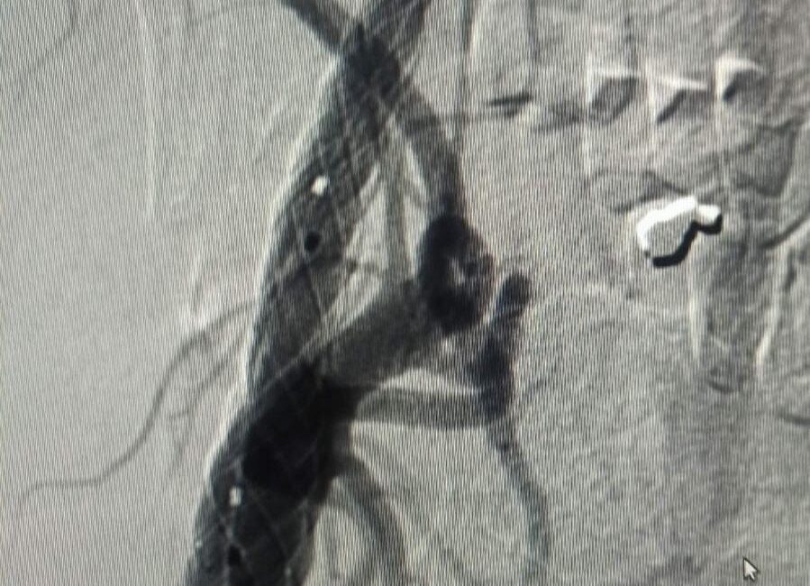Angioplastia