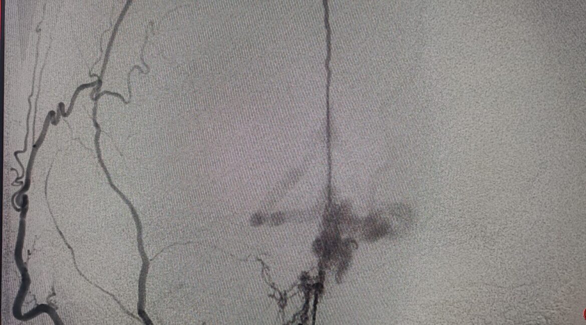 Embolização de fistula
