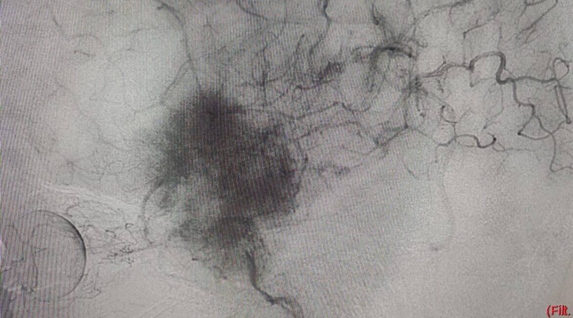 Embolização de tumor